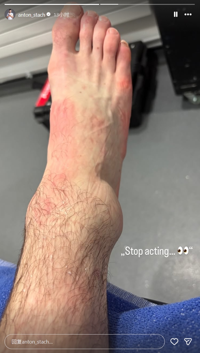 利兹联中场斯塔赫赛后晒伤情 脚踝肿胀如鸡蛋